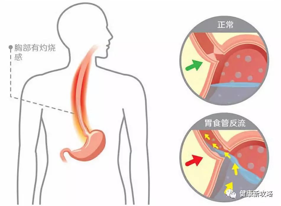 胃食反流早期治疗的重要性及策略探讨